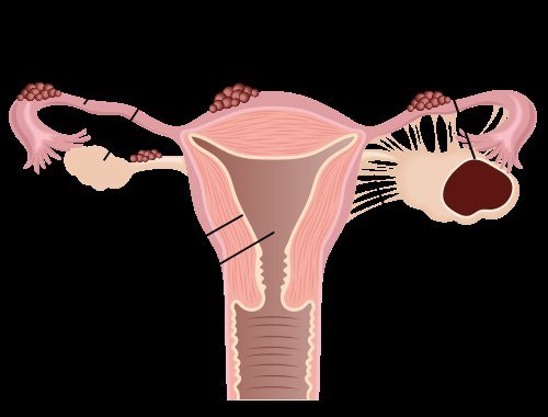 Career Disruption: How Endometriosis Affects Professional Lives