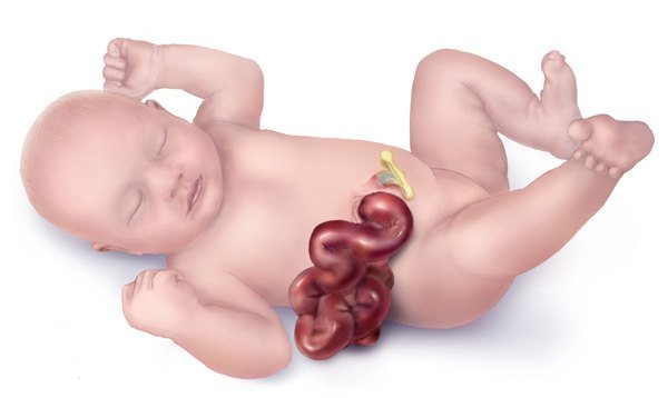 Baby Gets Special Surgery Before Birth