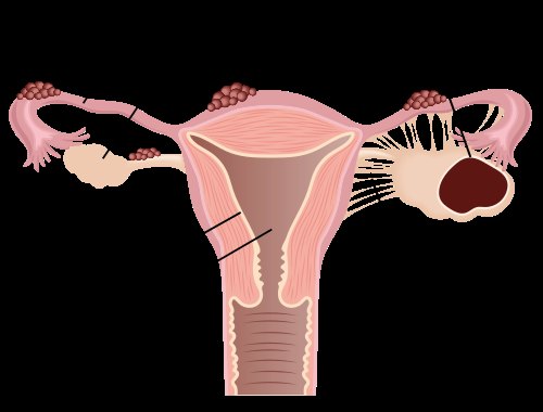 Building Support Networks for Endometriosis