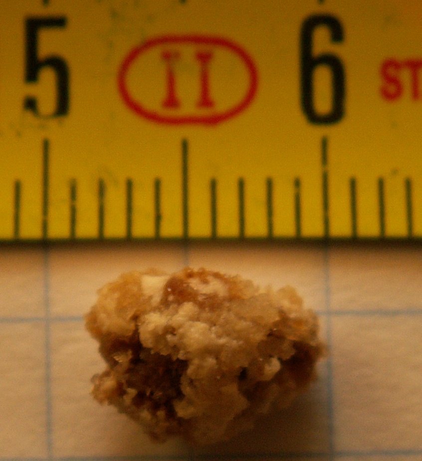 Surgeons Remove Exceptionally Large Bladder Stone