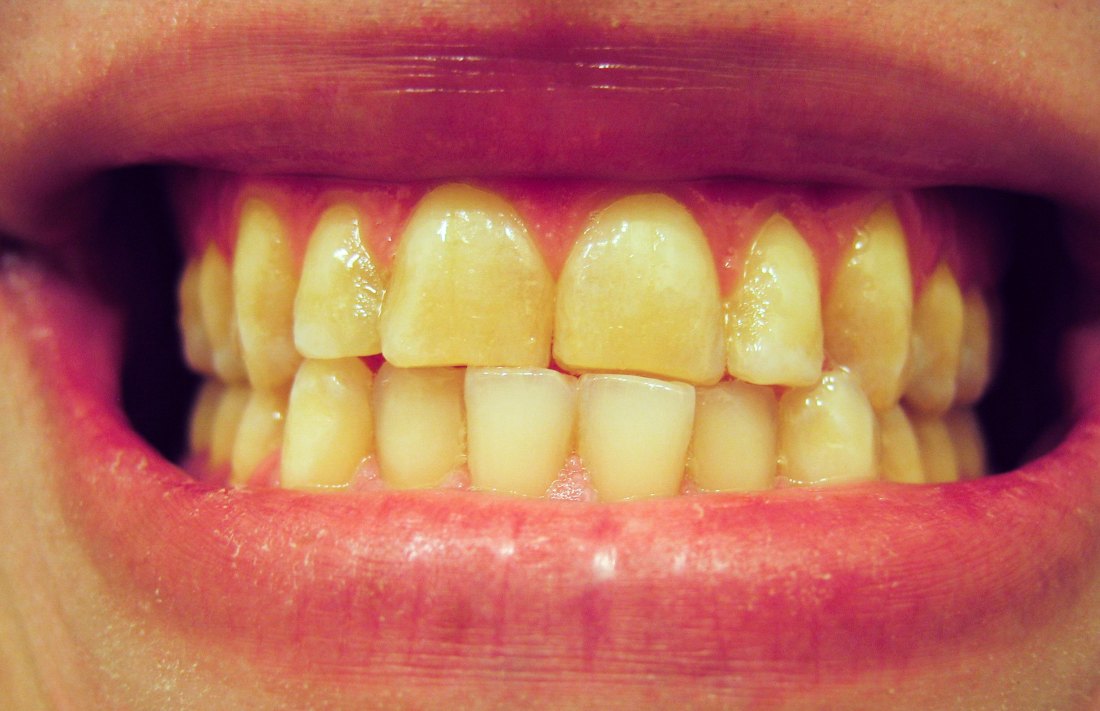 Young People Are Grinding Their Teeth More Often